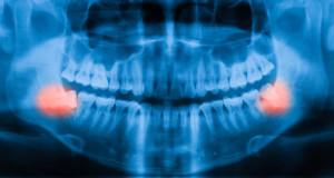 emergency wisdom teeth removal philadelphia