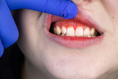 What Is Gingivitis and How to Treat It