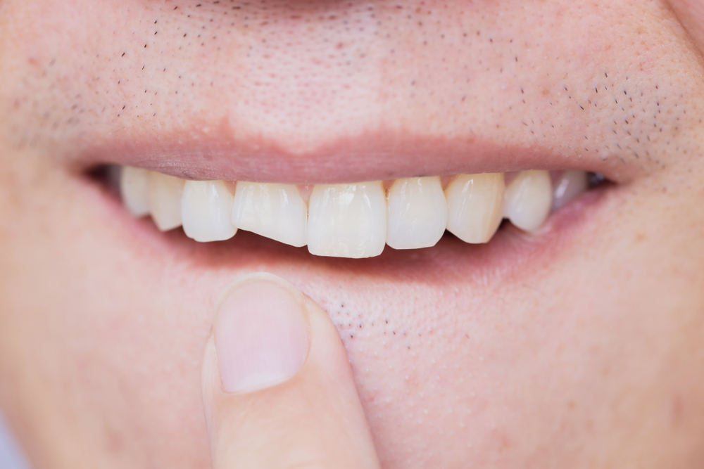 a close-up of a man's face with a finger pointing to a broken front tooth